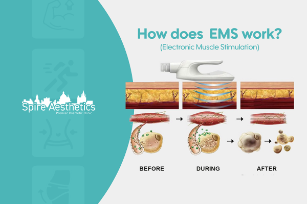 EMS treatment for post pregnancy weight loss treatment Bushey