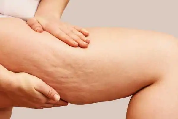 Image of woman showing leg with cellulite Bushey