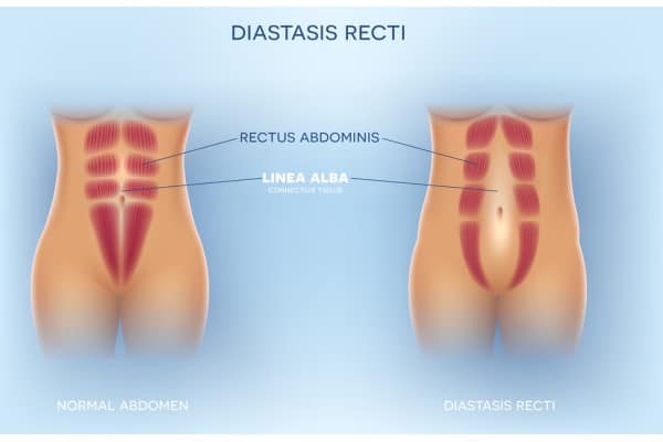 What Non-Surgical Options Are Available for Diastasis Recti Bushey?