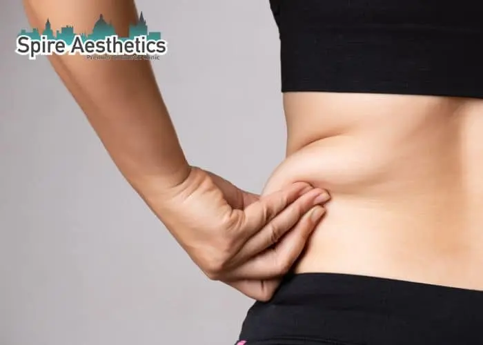 Image of woman pinching fat on their hips Bushey. Fat Freezing treatment