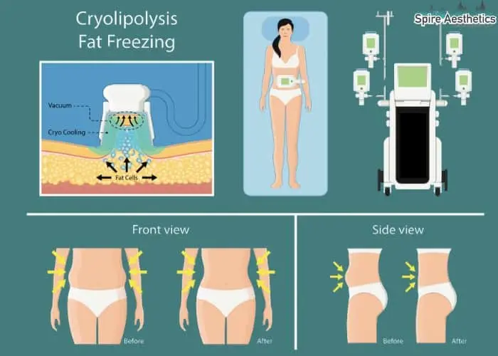 Fat freezing treatment Bushey benefits for competitions to remove stubborn fat deposits.