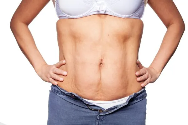 sagging skin on woman's stomach after weight loss injections Bushey