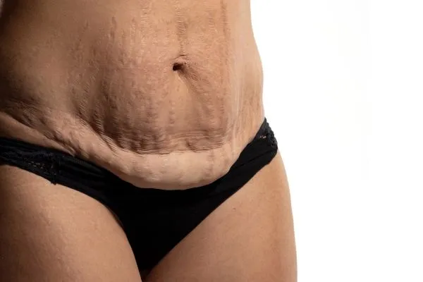 Image of womans stomach after weight loss injections Bushey showing saggy skin