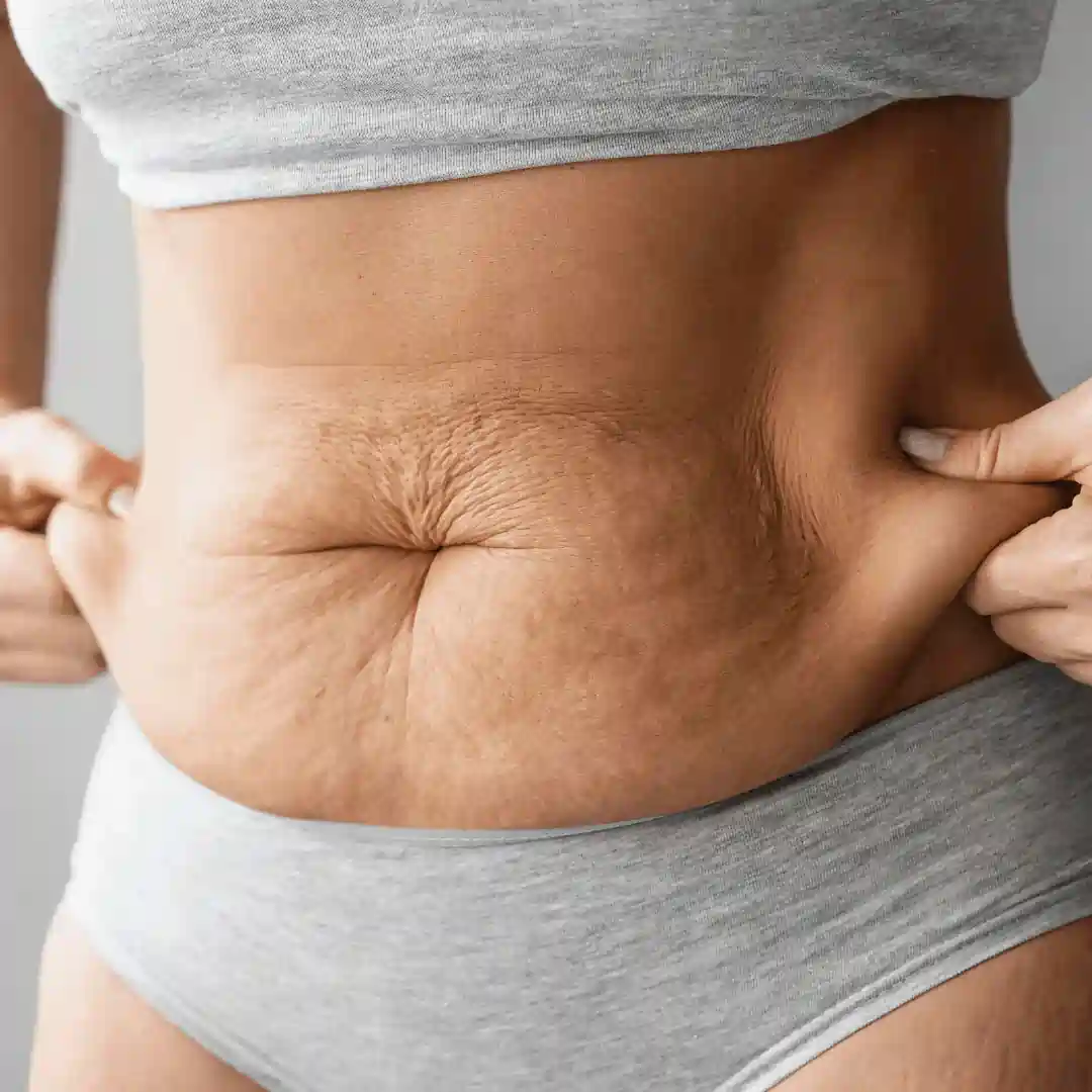 Is It Normal to Have Loose Skin After Pregnancy Bushey?