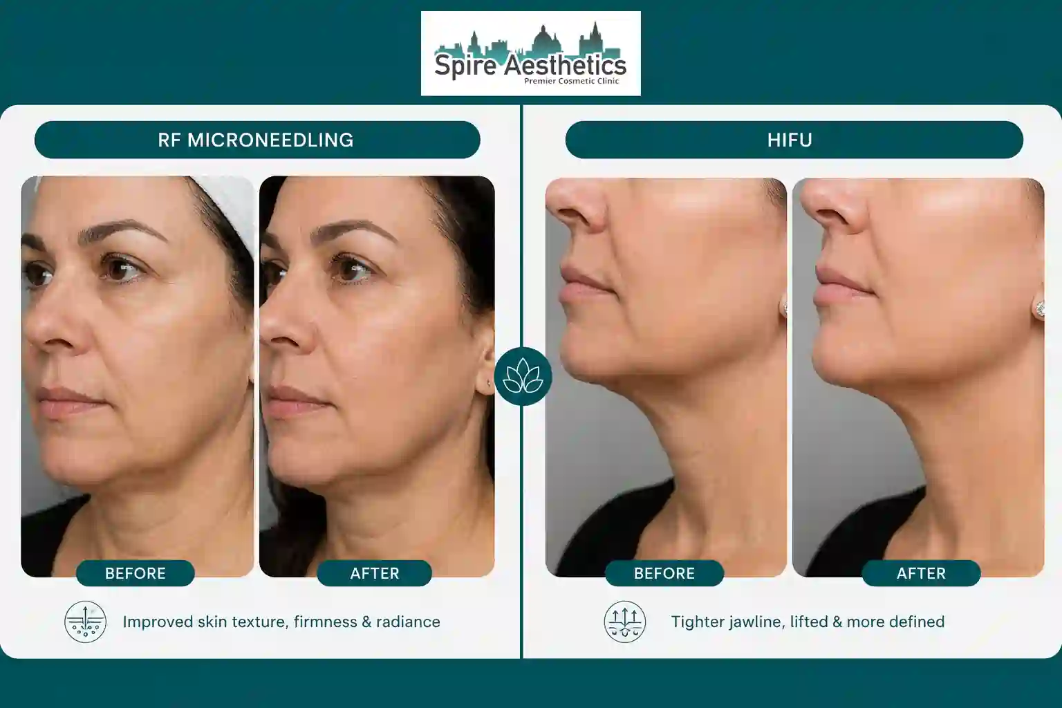Can RF Microneedling and HIFU Be Combined Bushey?