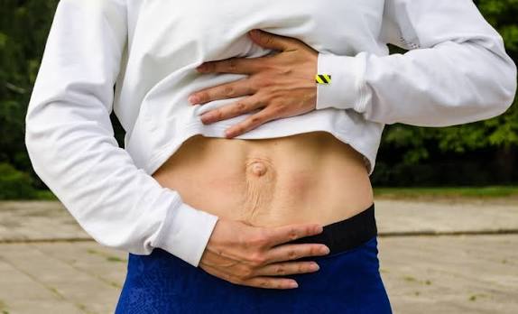 When Could Diastasis Recti Be the Missing Piece of the Puzzle Bushey?