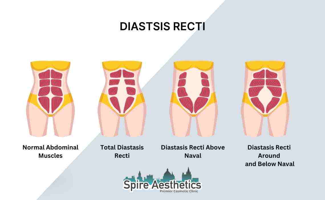 Is Non-Surgical Diastasis Recti Treatment Right for You? Common Concerns Answered Bushey